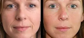 Polinucleótidos y relleno de ojeras: redefinir la mirada con ligereza y precisión